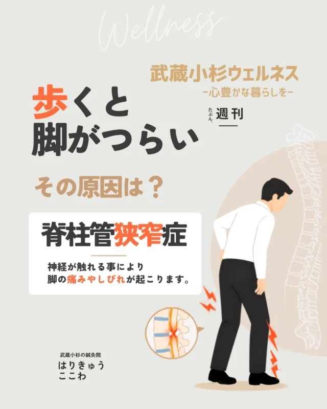 「しばらく歩くと足やお尻が痺れて痛くなり、歩けなくなる…」

「少し前かがみになって休むと、また歩けるようになる」

こんなお悩みはありませんか？

これは「間欠性跛行（かんけつせいはこう）」と呼ばれ、「脊柱管狭窄症（せきちゅうかんきょうさくしょう）」の代表的なサインです。

加齢や骨の変形、その他あらゆる負担によって、神経の通り道である「脊柱管」が狭くなり、神経や血管が圧迫されることで辛い痛みやシビレを引き起こします。
お出かけやお買い物が億劫になってしまうのは、本当に辛いですよね・・

『はりきゅうここわ』では、このような脊柱管狭窄症の辛い症状に対しても、【現代医学 × 東洋医学】の視点でしっかりとアプローチしていきます！

✅ 現代医学（構造的）なアプローチで「患部の負担を減らす」
狭窄症の方は、立位や歩行を始め、腰を反らせる姿勢をとると、構造上、神経の圧迫が強まり、症状が悪化しやすい特徴があります。

骨盤の傾きや股関節周り状態など、腰に負担をかけている「姿勢のクセ」を見つけ出します。
そして、うまく使えていない筋肉や関節の可動域を本来あるべき姿へとなるよう、神経への物理的なストレスを減らす身体づくりを行います。

✅ 東洋医学（鍼灸）のアプローチで「深部の血流を促す」
東洋医学に基づき体質に合わせた鍼灸を行うと、体全体の血や気の巡りを調整でき、人間が本来持つ自然治癒力を高めることで、辛いシビレの緩和を目指します✨

「もう年だから仕方ないと言われた・・」

「手術はできるだけ避けたい・・」

そんな不安を抱えている方は、一人で悩まずにぜひ一度ご相談ください。
少しでも長く、ご自身の足で楽しく歩けるよう、現在のお身体の状態に合わせた最適な施術をご提案いたします🍀

📍 店舗情報
【武蔵小杉 はりきゅうここわ】
ご予約・詳細はプロフィール @harikyu_kokowa のリンクからご確認ください🔗

#鍼灸院 #はりきゅうここわ #脊柱管狭窄症 #坐骨神経痛 #間欠性跛行 #足のしびれ #腰痛改善 #武蔵小杉で鍼灸のある心地よい暮らし #東洋医学 #武蔵小杉